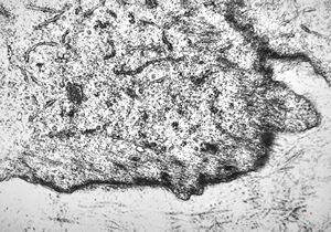 F,80y. | leiomyosarcoma - thigh F,80y. | leiomyosarcoma - thigh